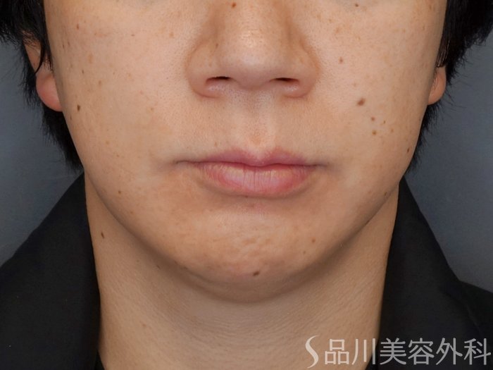 症例NO.72965のBEFORE写真