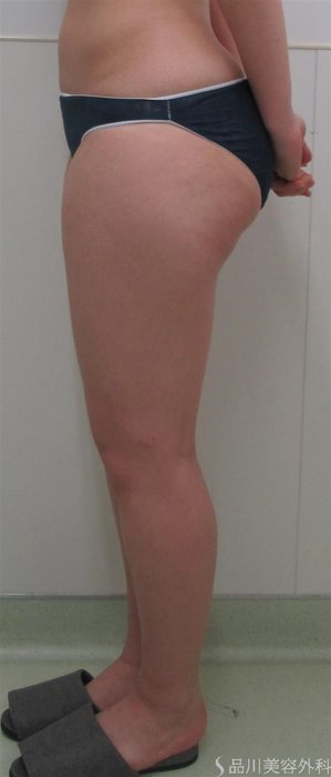 症例NO.27734のBEFORE写真
