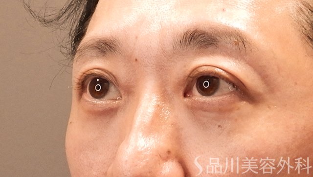 症例NO.75058のAFTER写真