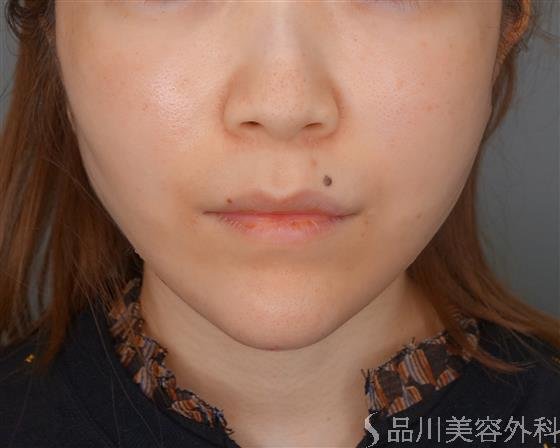症例NO.53830のAFTER写真