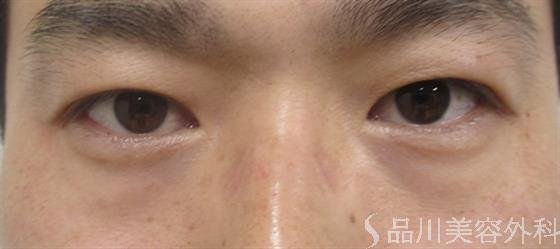症例NO.35523のAFTER写真
