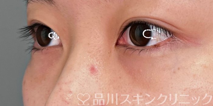 症例NO.69879のBEFORE写真