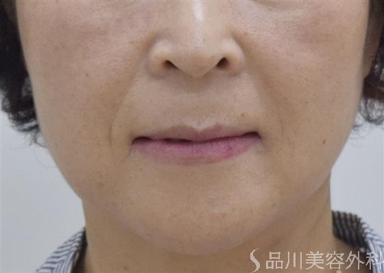 症例NO.49182のBEFORE写真