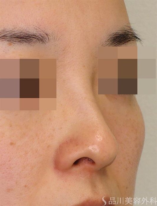 症例NO.47876のBEFORE写真