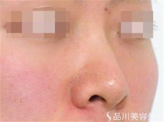 症例NO.27041のBEFORE写真