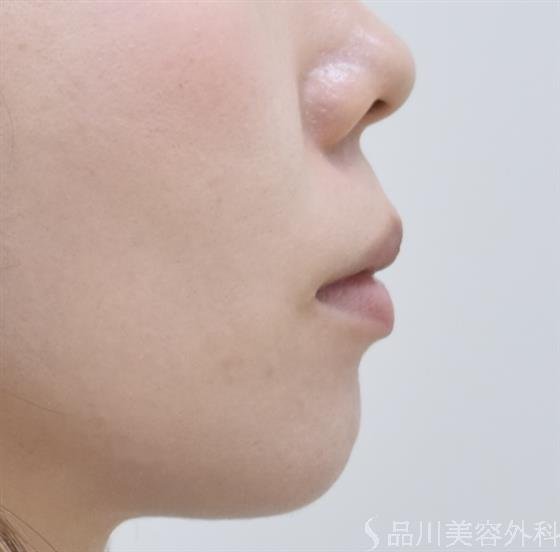 症例NO.44114のBEFORE写真