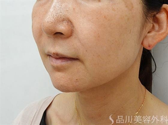 症例NO.44611のBEFORE写真