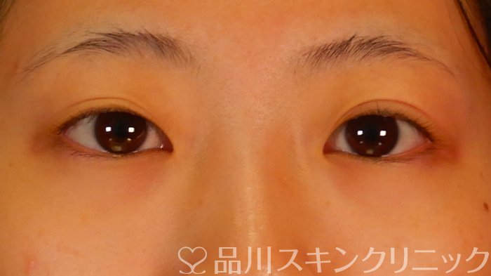症例NO.69209のBEFORE写真