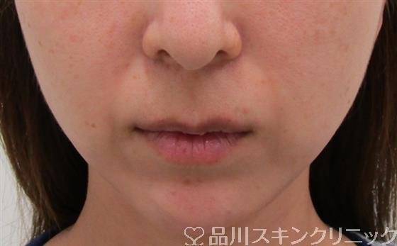 症例NO.43218のBEFORE写真