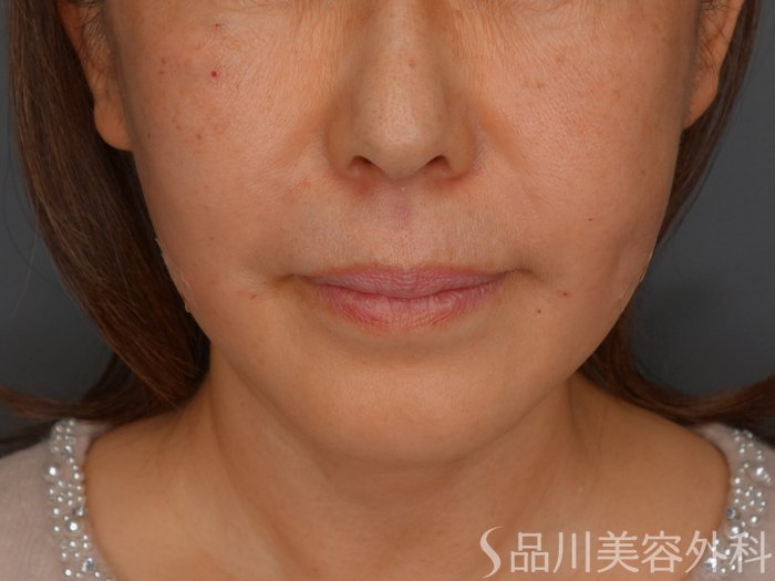 症例NO.73278のAFTER写真