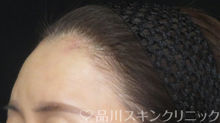 症例NO.70773のAFTER写真