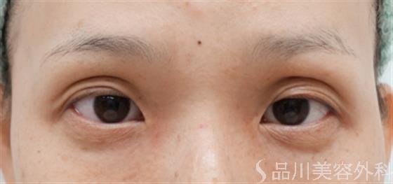 症例NO.30600のBEFORE写真