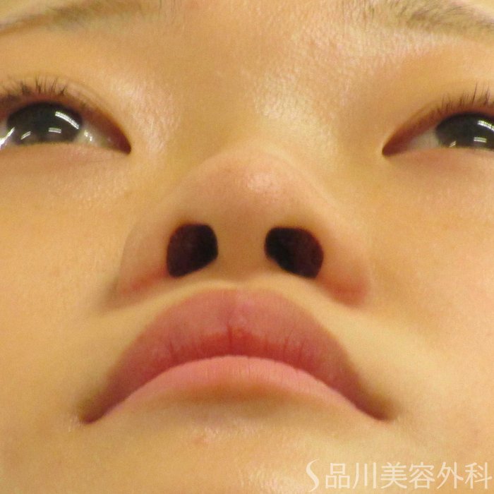 症例NO.62383のAFTER写真
