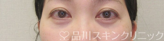 症例NO.69585のAFTER写真