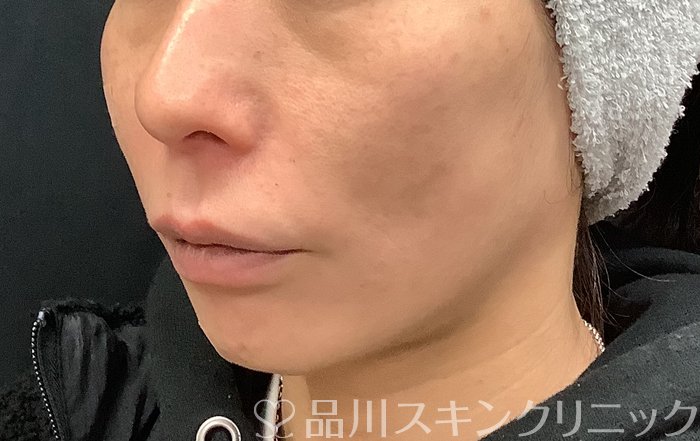 症例NO.69485のAFTER写真