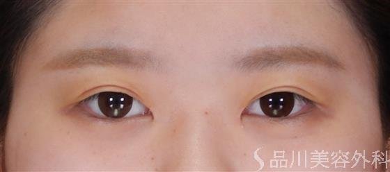 症例NO.56642のAFTER写真