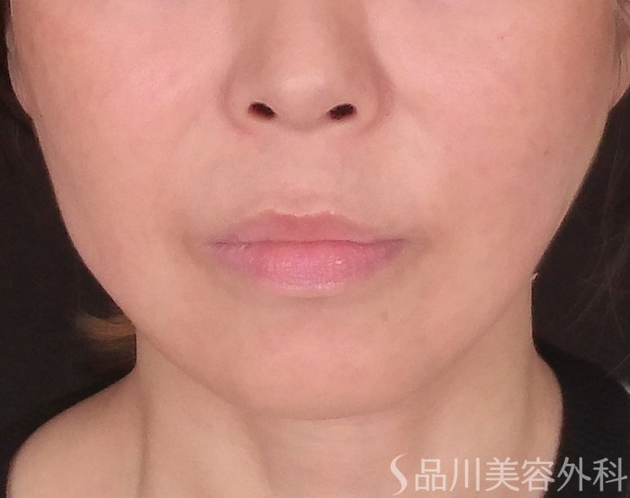 症例NO.70084のAFTER写真
