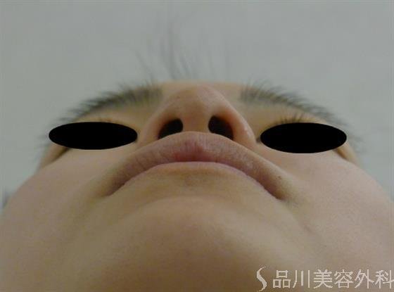 症例NO.50112のBEFORE写真