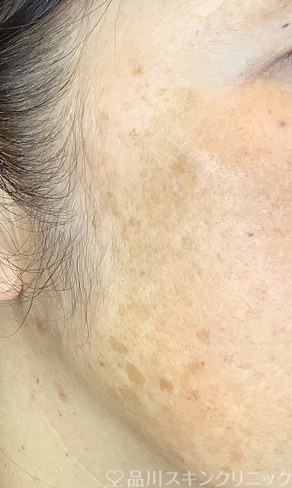 症例NO.74753のBEFORE写真