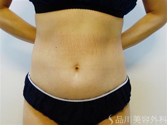 症例NO.51325のAFTER写真