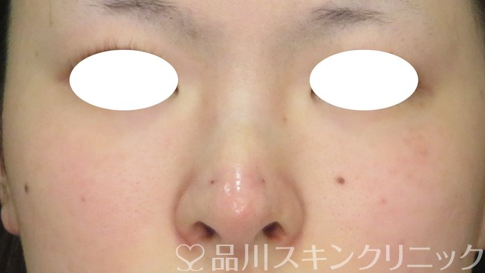 症例NO.74023のAFTER写真