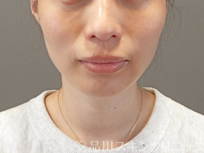 症例NO.66268のAFTER写真