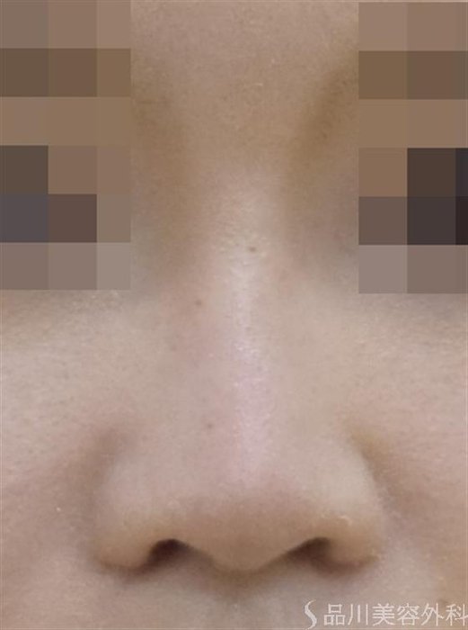 症例NO.50691のAFTER写真