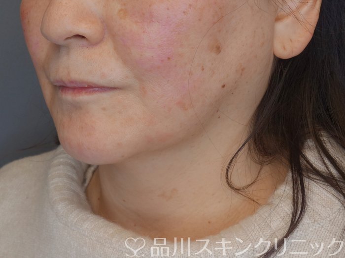 症例NO.72593のAFTER写真