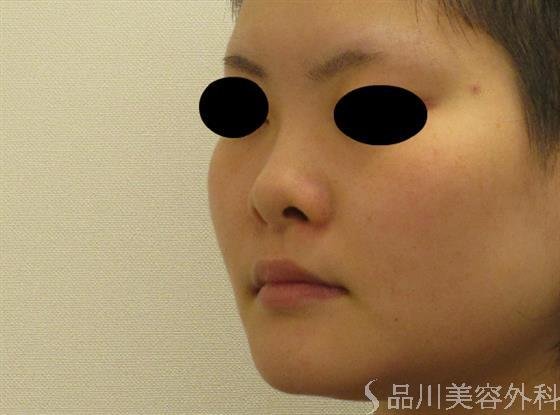 症例NO.49522のBEFORE写真