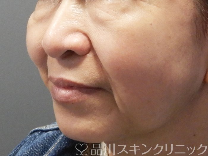 症例NO.72395のBEFORE写真