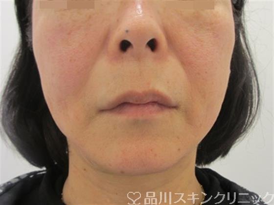 症例NO.39031のAFTER写真