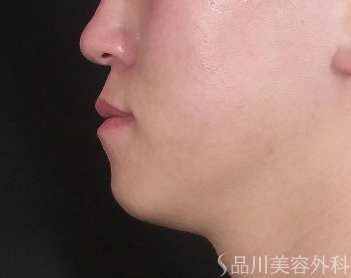 症例NO.65551のBEFORE写真