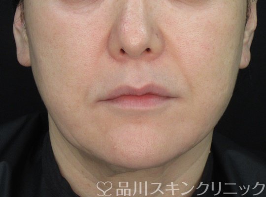 症例NO.71944のBEFORE写真