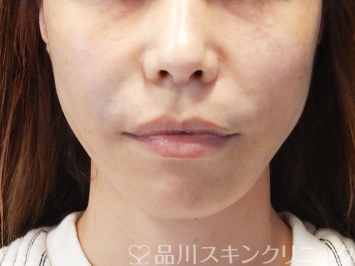 症例NO.73001のAFTER写真