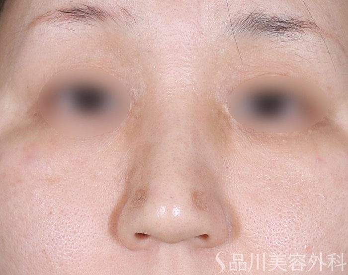 症例NO.72589のAFTER写真