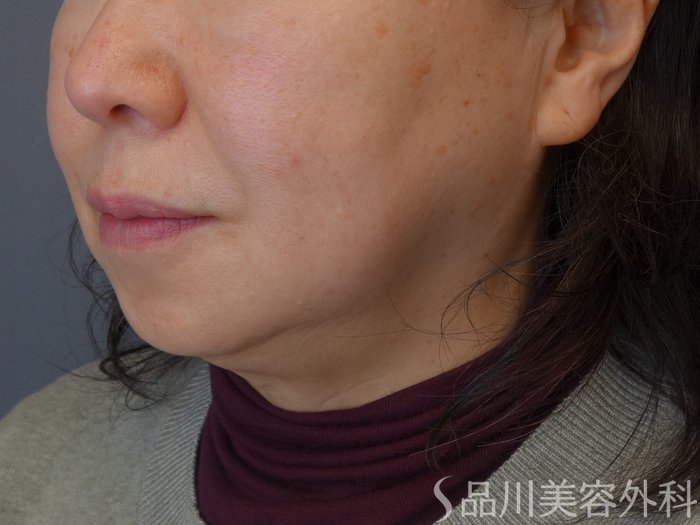 症例NO.72547のBEFORE写真