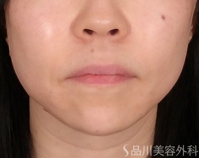 症例NO.70030のAFTER写真