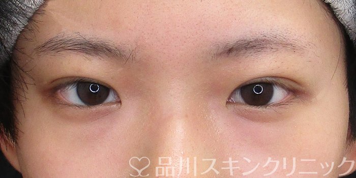 症例NO.73028のAFTER写真