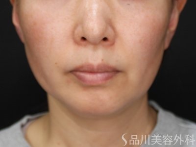 症例NO.74689のBEFORE写真