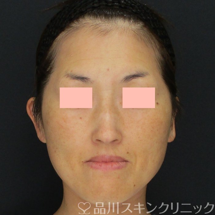 症例NO.73571のAFTER写真