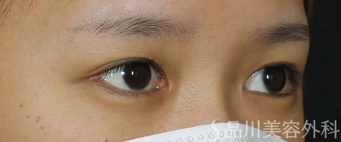 症例NO.69535のBEFORE写真