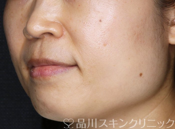 症例NO.66413のBEFORE写真
