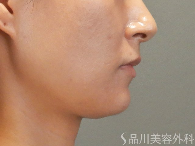 症例NO.71816のAFTER写真