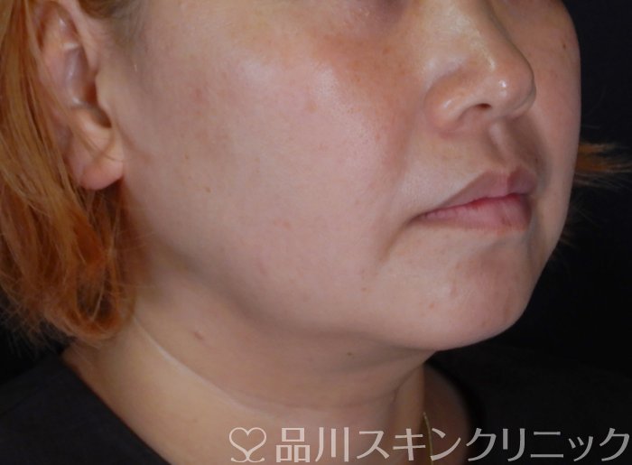 症例NO.66910のBEFORE写真