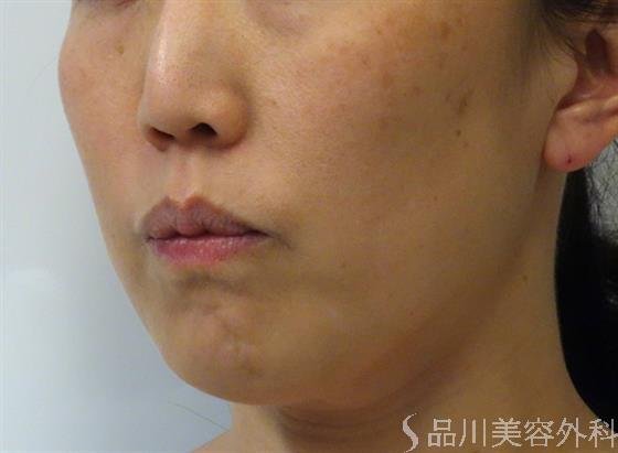 症例NO.41206のAFTER写真