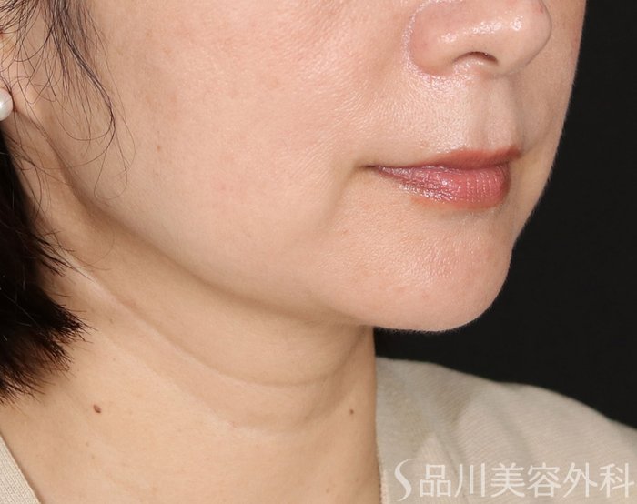 症例NO.71046のAFTER写真