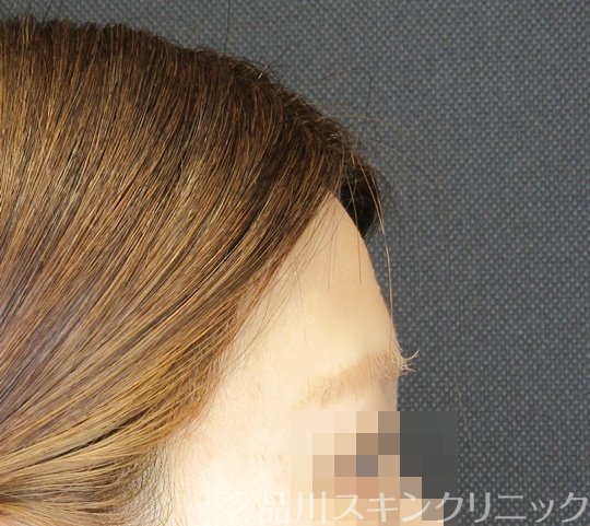 症例NO.71476のBEFORE写真