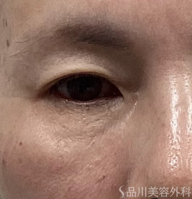 症例NO.68153のBEFORE写真