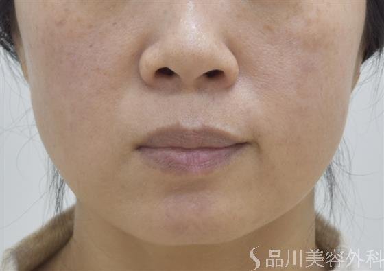 症例NO.47066のBEFORE写真