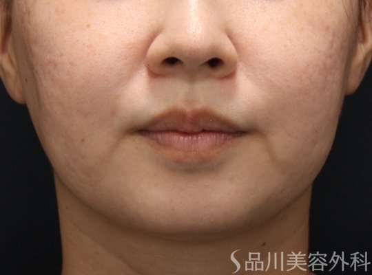 症例NO.75180のBEFORE写真